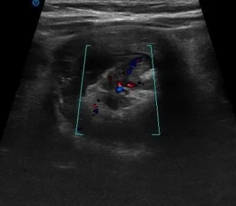 bélelzáródás az USA-ban (előadás diagnostere)