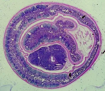 bélelzáródás az USA-ban (előadás diagnostere)