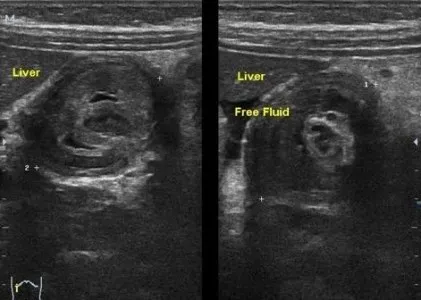 bélelzáródás az USA-ban (előadás diagnostere)