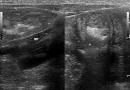 bélelzáródás az USA-ban (előadás diagnostere)