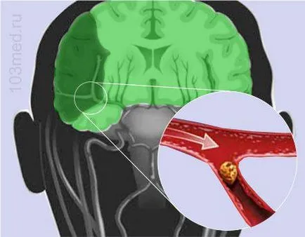 A stroke következményei a férfiak és a nők a jobb és a bal oldalon