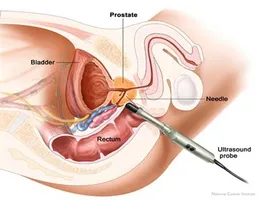 Cum ofloxacina prostata