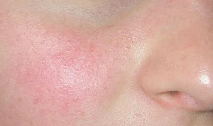 Hogyan kell kezelni rosacea az arc, az új kozmetológiai