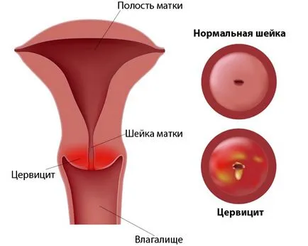 Hogyan kezeljük cervicitis (krónikus, gennyes, virális, a nem-specifikus) - antibiotikumok,