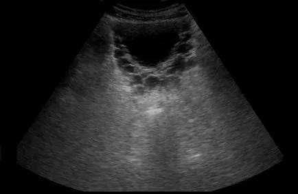 Как е ултразвуковото изследване на пикочния мехур