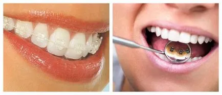 Как да направите красива усмивка зъби метод 3 изправяне