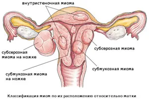 FUS ablația fibrom uterin - comentarii, fotografii de cost