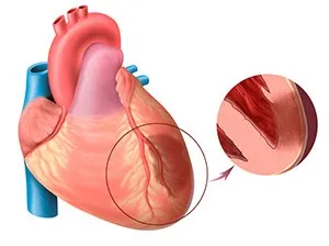Gastralgicheskaya форма на инфаркт на миокарда - сърцето третиране