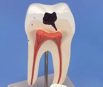 Зъбният кариес - болест на века