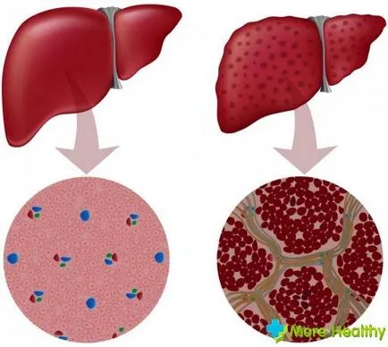 cauze hepatice Chist și metode de tratament populare