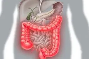 Colitis, béltüneteik felnőtteknél, a vastagbélgyulladás kezelésére, étrend