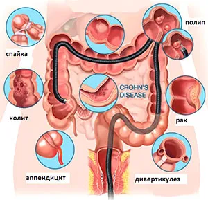 pregatire intestinului colonoscopie pentru procedura de purgație