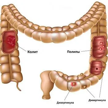 Colitis, béltüneteik felnőtteknél, a vastagbélgyulladás kezelésére, étrend