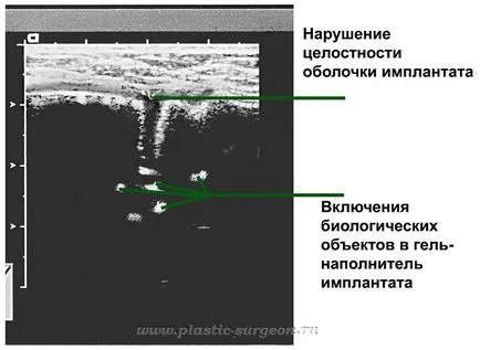 Clinic - artimeda - ultrahangos emlő implantátumok