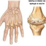 Kezelés deformáló osteoarthritis (DOA)