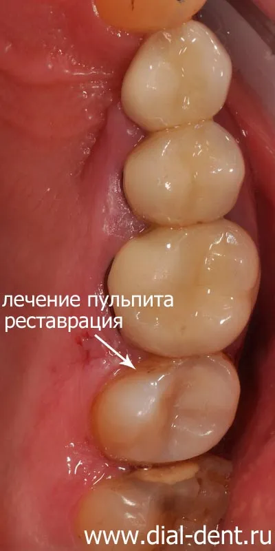 Лечение на пулпит с микроскоп