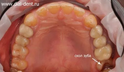 Tratamentul pulpitei cu un microscop