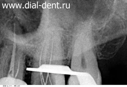 Tratamentul pulpitei cu un microscop