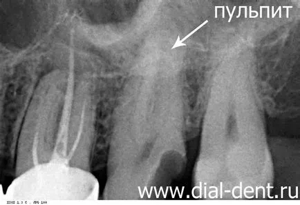 Tratamentul pulpitei cu un microscop