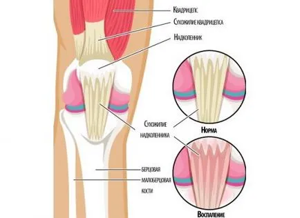 Kezelése bursitis a térd liba láb
