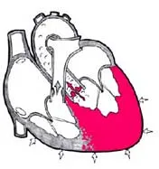 Hipertrofiei ventriculului stâng al inimii - tratamentul si simptomele - Enciclopedia medical - dvs.