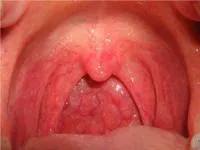 Hipertrófiás pharyngitis tünetek, kezelés, okai