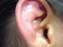 Хематом на ухото симптоми и лечение