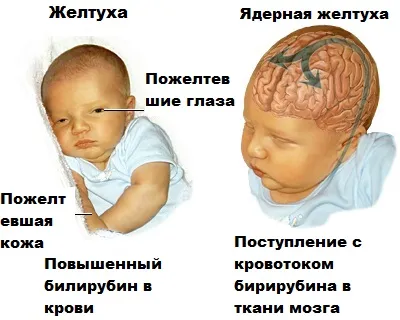 A hemolitikus sárgaság (nukleáris, patológiás) csecsemőknél tünetek és kezelés