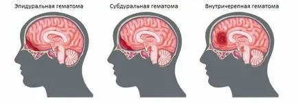 Хематом на симптомите на главата и лечение