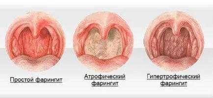 Hipertrófiás pharyngitis tünetek, kezelés, okai