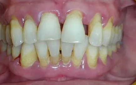 Generalizált periodontitis etiológiájú fokozat, diagnózis és megelőzés