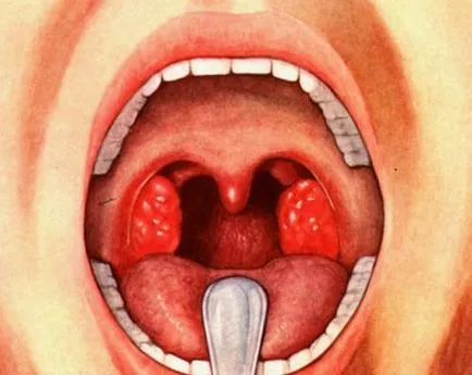 Hipertrófiás pharyngitis tünetek, kezelés, okai