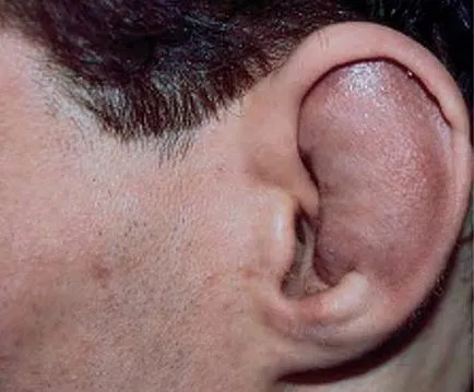 Хематом на ухото симптоми и лечение