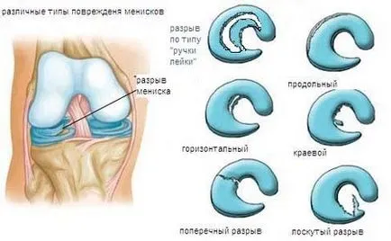 A meniszkusz a térd, az ár a műveletet, ha sérült meniszkusz a térd, a kezelés