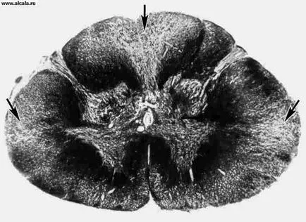 Mieloperoxidaza, mielopoliradikulonevrit Enciclopedii medical