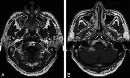 MRI az orrmelléküregek St. Petersburg - a cím és az ár, amely megmutatja MRI az orrmelléküregek, hogy diagnosztizált olcsó