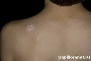 Nevus Sutton tünetei, diagnózisa és kezelése Áttekintés