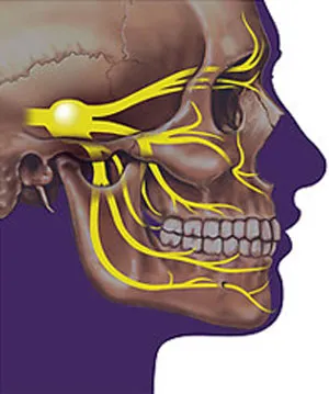 Trigeminus neuralgia és a számítógépes kés