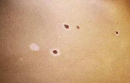 Nevus Sutton tünetek, okok, diagnózis és kezelés