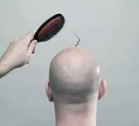 alopecia areata