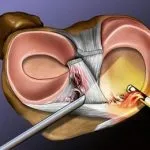 Операция на менискус - видове и разходите
