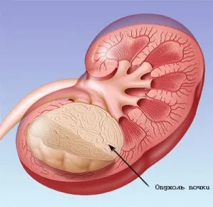 Kidney туморни симптоми и лечението