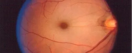 Оклузия на централната ретинална артерия - опасните, симптоми и лечение на сайта ни