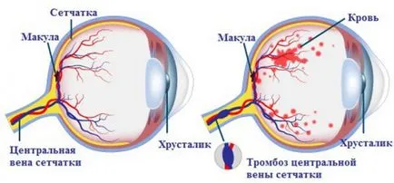 Оклузия на централната ретинална артерия - причини, симптоми и лечение