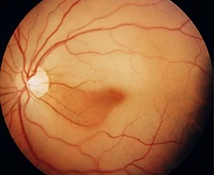 Оклузия на централната ретинална артерия - причини, симптоми и лечение 1