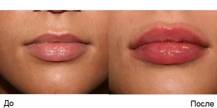 Подуване след устна увеличаване хиалуронова киселина, които направят