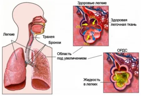 simptome edem pulmonar, cauze, efecte