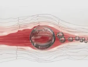 Az atherosclerosis - szövődmények, megelőzésére és kezelésére