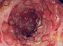 colon polyposis család, diffúz, adenomatózus