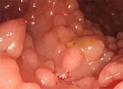 colon polyposis család, diffúz, adenomatózus